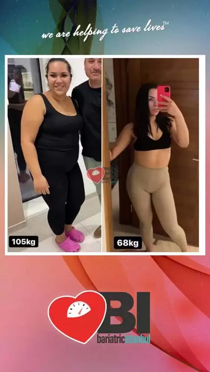 Metabolic Surgery at Turkey Before&After Photos