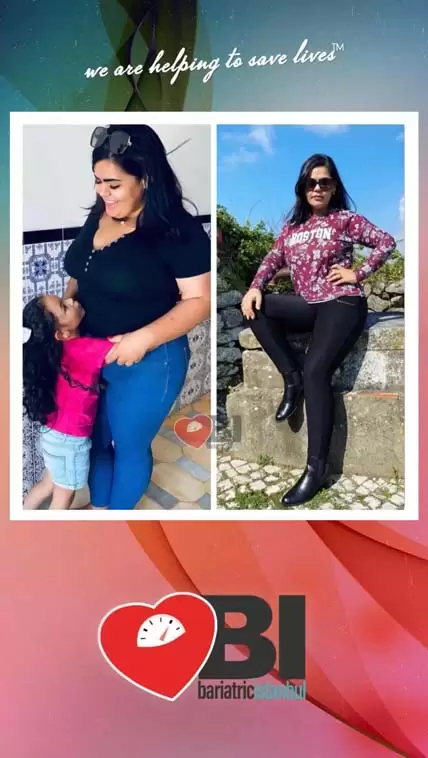 Gastric Sleeve Turkey Before&After Photos