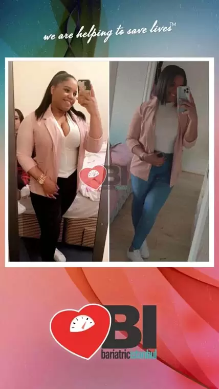 Gastric Sleeve Turkey Before&After Photos