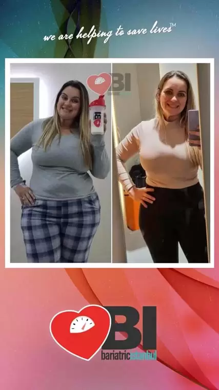 Gastric Balloon Turkey Before&After Photos