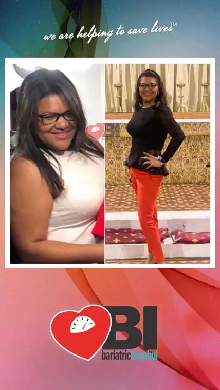 Cirurgia de Obesidade de Revisão Fotos Antes&Depois