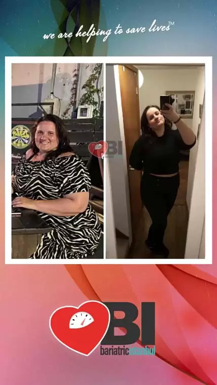 Gastric Sleeve Turkey Before&After Photos