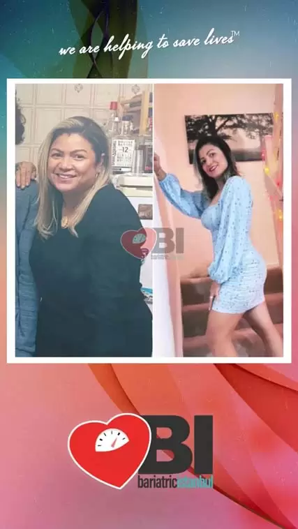 Revisional Bariatric Surgery Before&After Photos