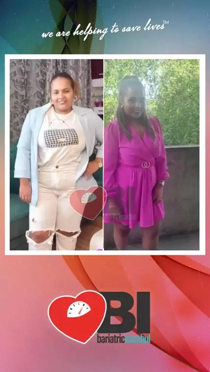 Revisional Bariatric Surgery Before&After Photos