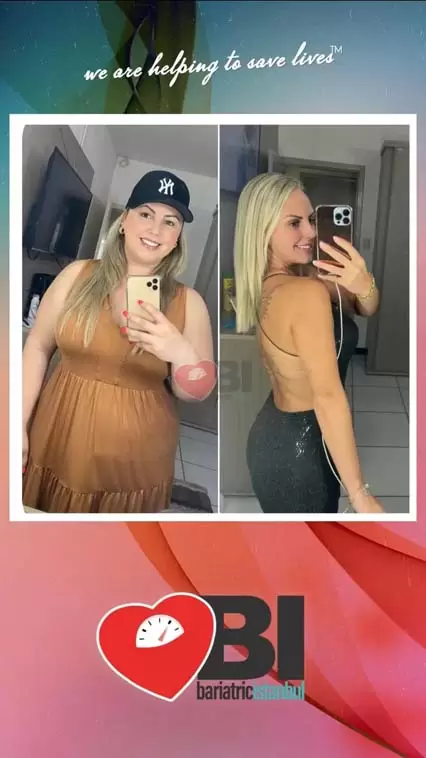 Stomach Balloon Removal Turkey Before&After Photos