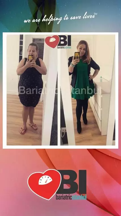 Gastric Balloon Turkey Before&After Photos