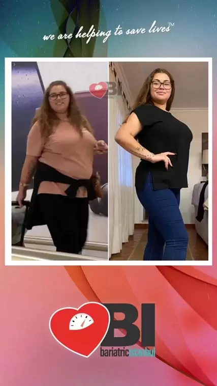 Gastric Balloon Turkey Before&After Photos