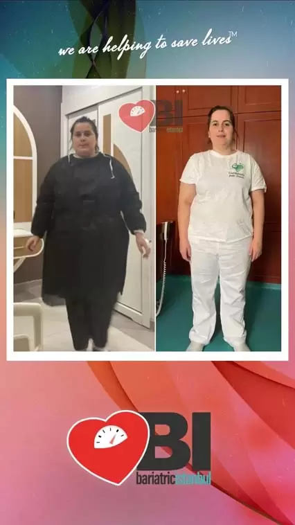 Full Gastric Bypass Turkey Before&After Photos