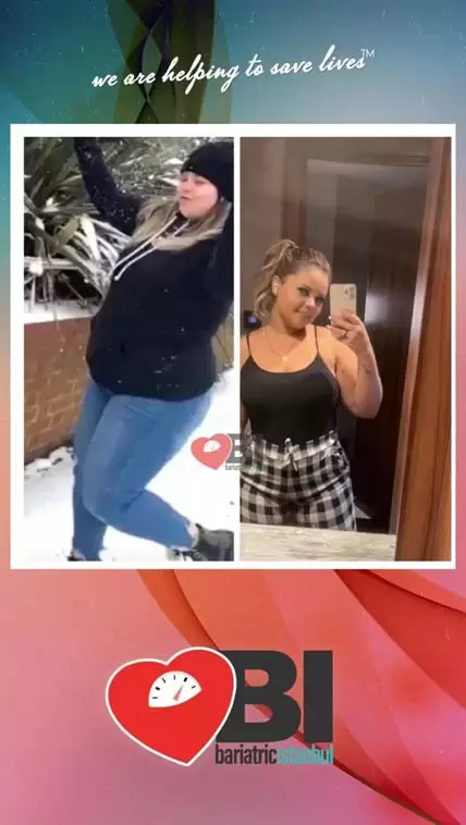 Full Gastric Bypass Turkey Before&After Photos