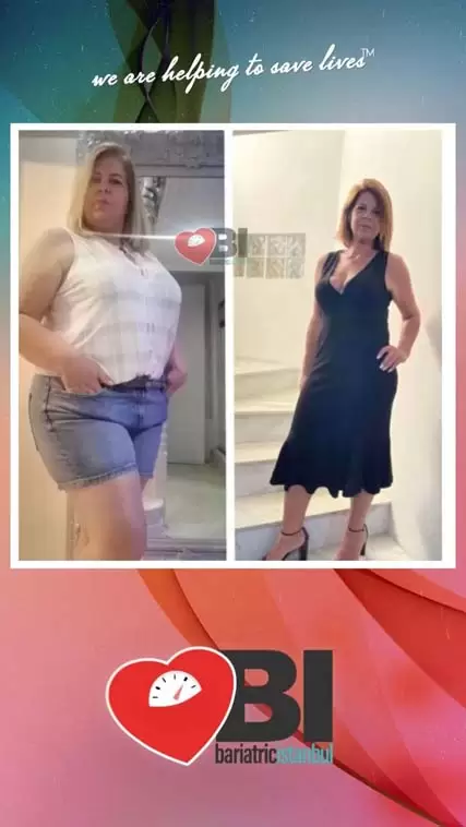 Mini Gastric Bypass Turkey Before&After Photos
