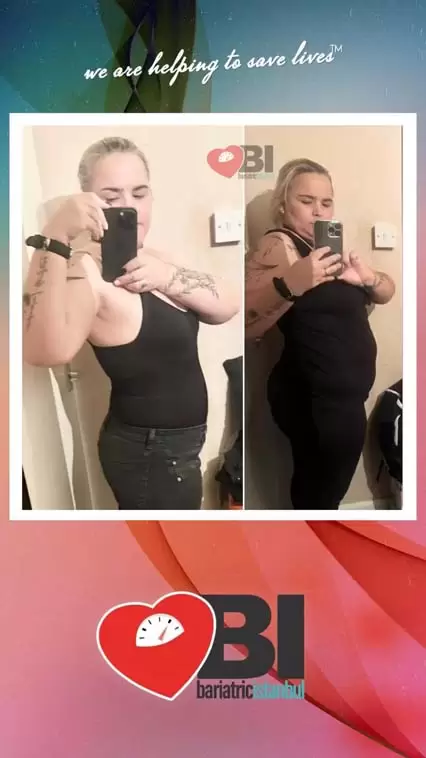 Full Gastric Bypass Turkey Before&After Photos