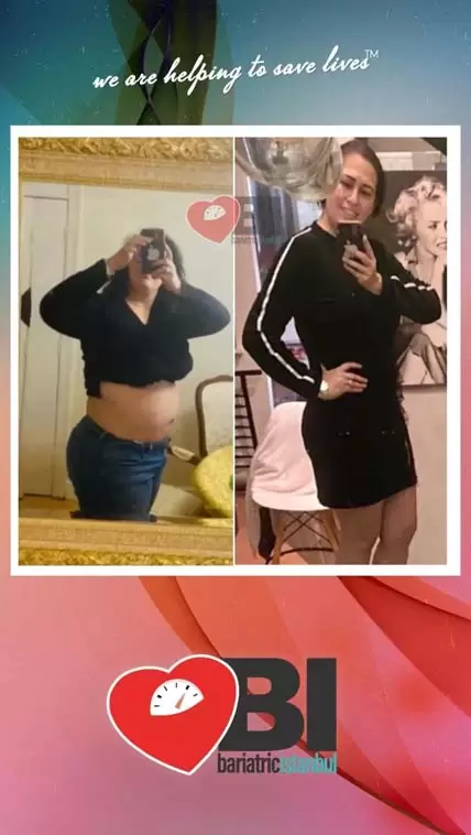 Full Gastric Bypass Turkey Before&After Photos