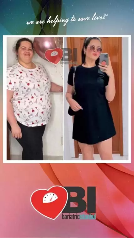 Metabolic Surgery at Turkey Before&After Photos