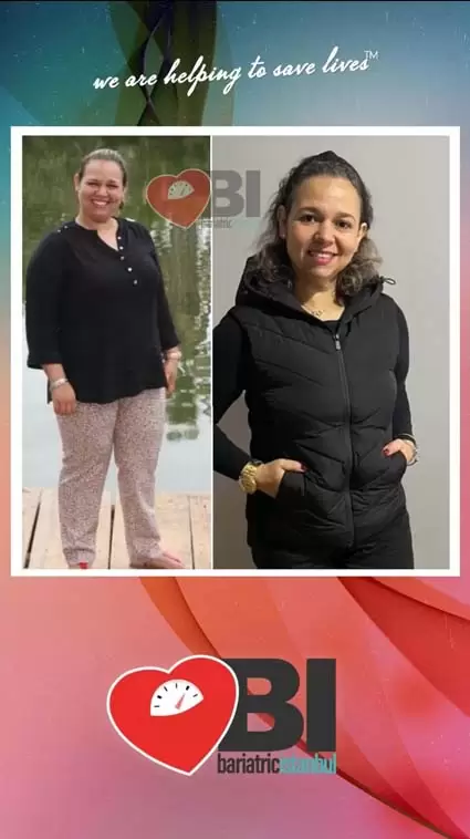 Gastric Sleeve Turkey Before&After Photos