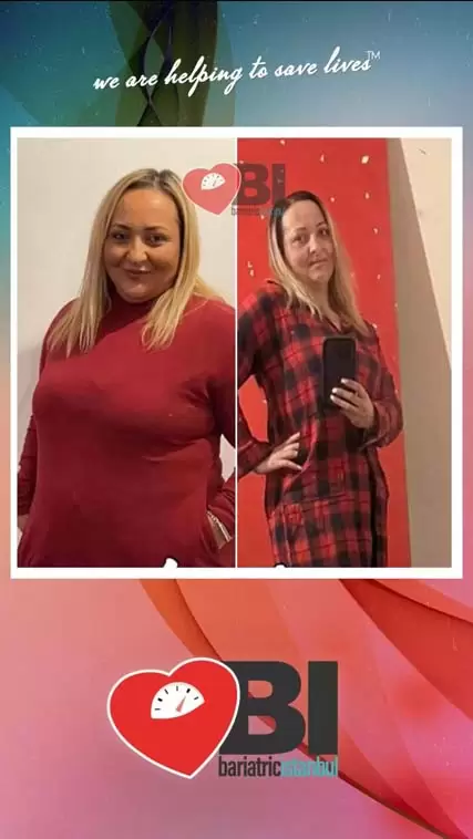 Mini Gastric Bypass Turkey Before&After Photos