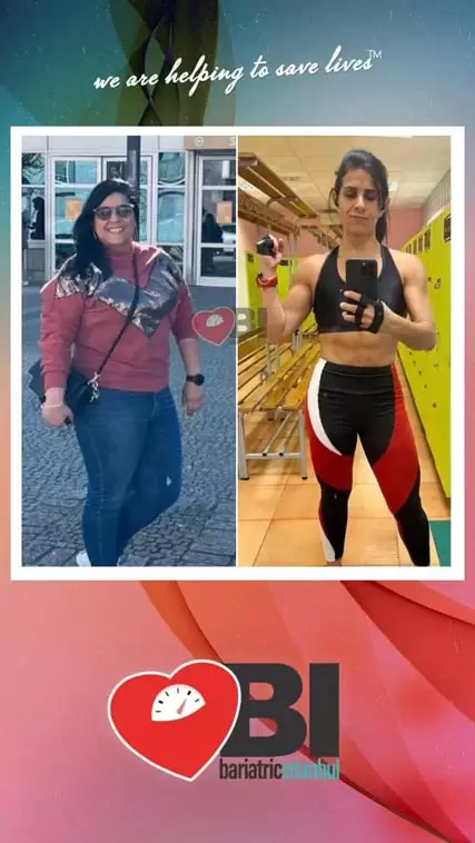 Metabolic Surgery at Turkey Before&After Photos